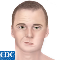 Bell's palsy Bell's palsy