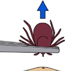 How to Pull a Tick