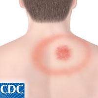 Erythema migrans Erythema migrans